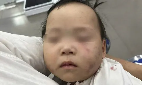 Công an tạm giữ cô giáo trong vụ bé gái bị bầm tím mặt khi gửi nhà trẻ