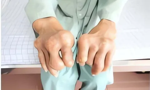 Tay chân biến dạng, đầy u cục sau khi tự điều trị gout