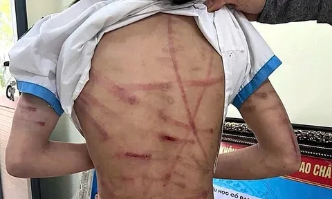 Bắt giữ cha dượng bạo hành dã man bé gái lớp 5 ở Hà Tĩnh